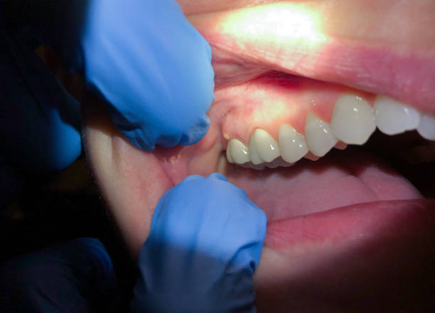 Best Emergency Denture Repair in Johnstown, CO